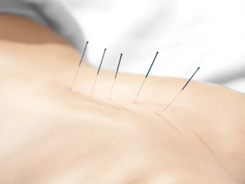 Acupuncture at Atnip Chiropractic in Owensboro