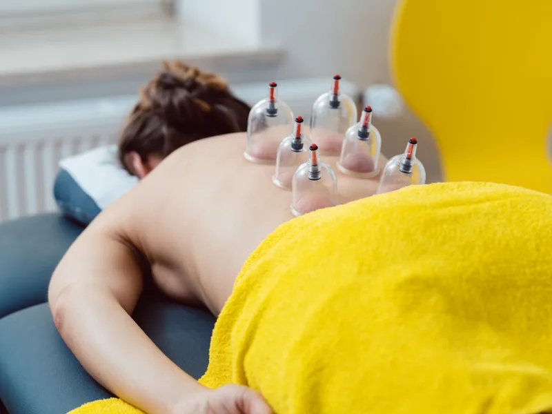 Cupping Therapy at Atnip Chiropractic in Owensboro