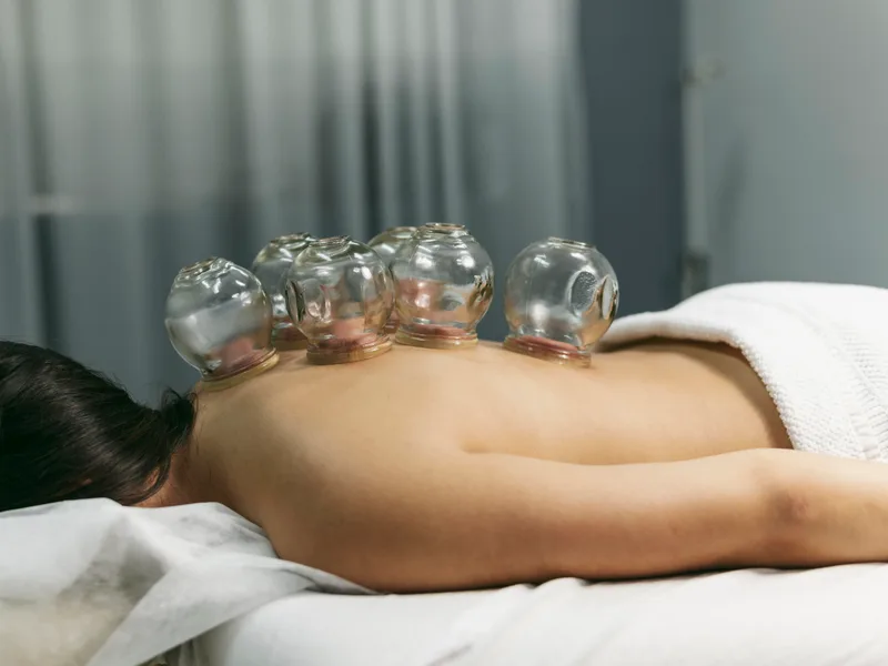 Cupping Therapy at Atnip Chiropractic in Owensboro