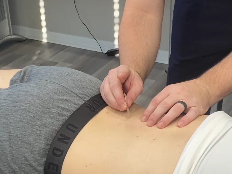 How Dry Needling works at Atnip Chiropractic