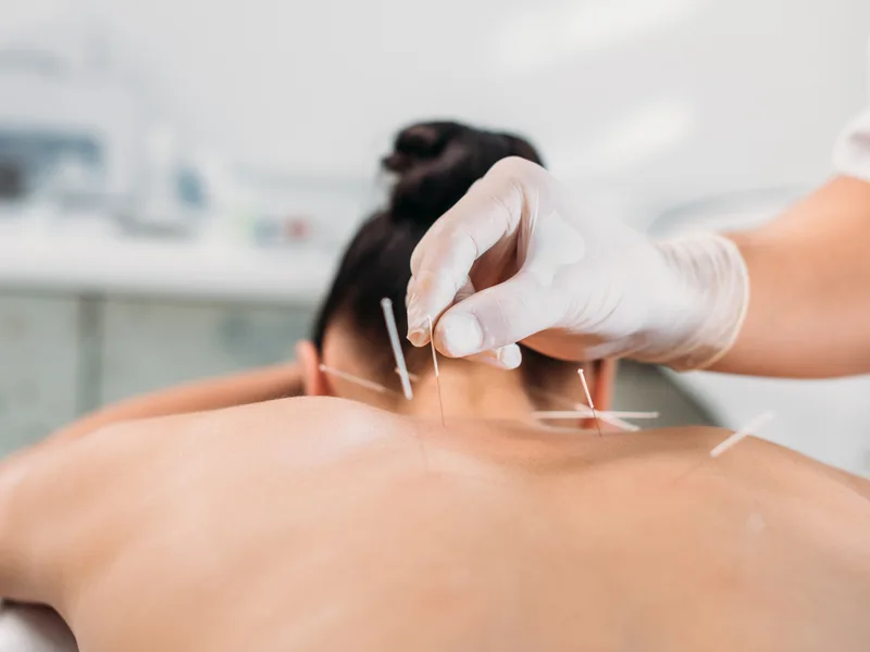 Dry Needling at Atnip Chiropractic in Owensboro